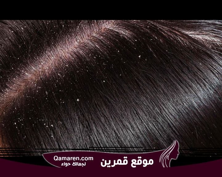 Photo of علاج قشرة الشعر نهائيا – كيفية التخلص من قشرة الشعر في 7 أيام