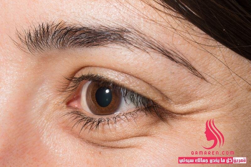 علاج تورم العين - أفضل 13 وصفة وكريم للعلاج الفوري للتورم!
