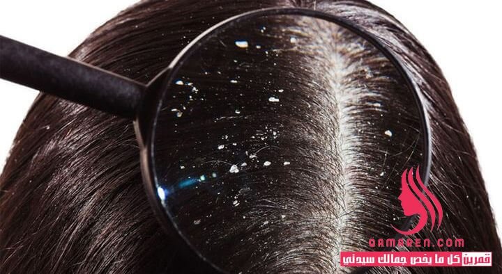 أفضل 10 علاجات للتخلص من قشرة الشعر نهائيا