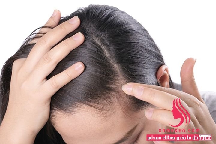 علاج قشرة الشعر بشكل فعال